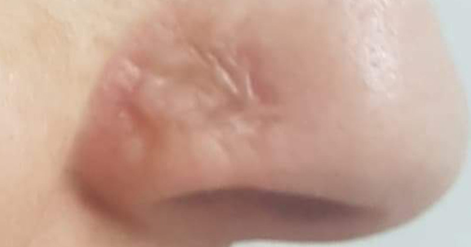 Micro-Needling-for-Injury-Scar_After1