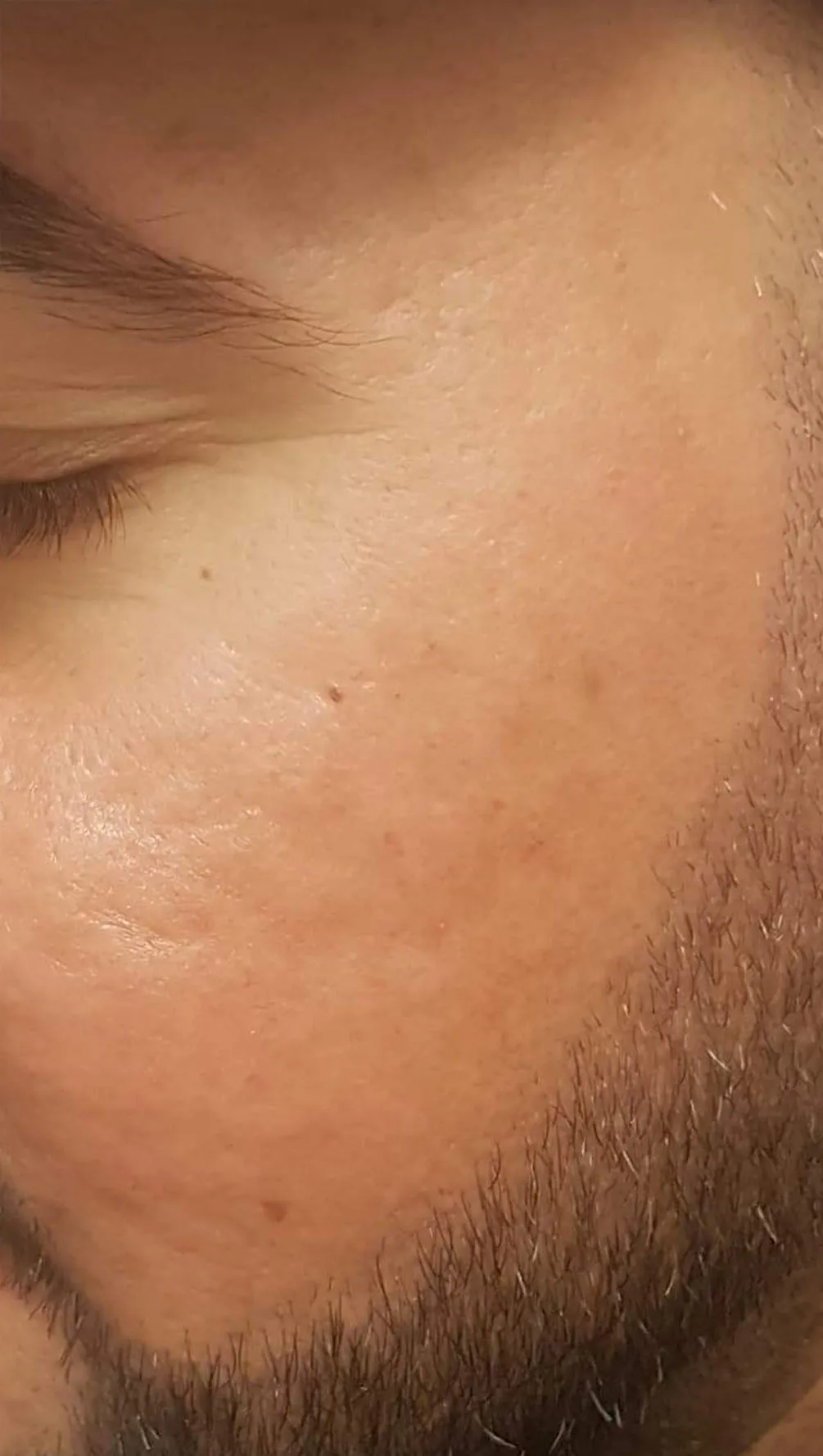 02_Fractional-co2-Laser-Deep-Acne-Scar-and-Pigmentation-Reduction_After
