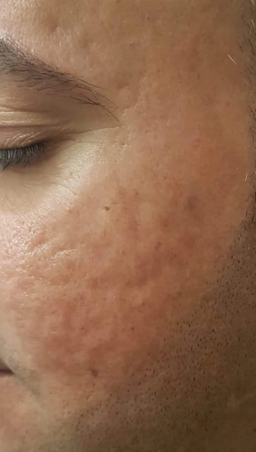 02_Fractional-co2-Laser-Deep-Acne-Scar-and-Pigmentation-Reduction_Before