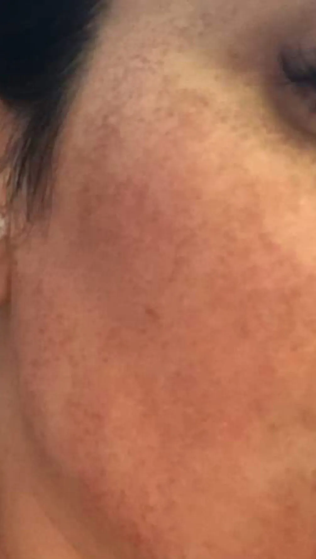 04_Fractional-co2-Laser-Deep-Acne-Scar-and-Pigmentation-Reduction_Before