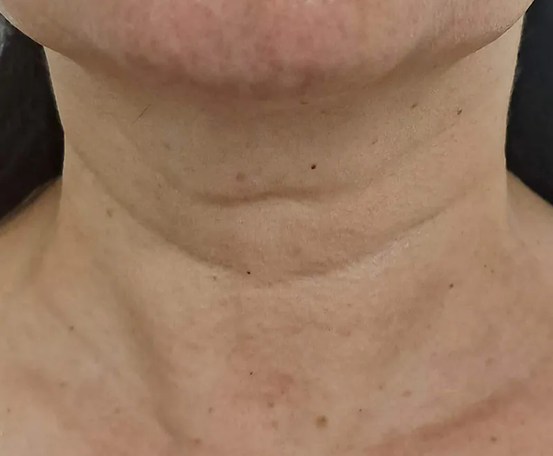 16-Hifu-Face-and-Neck-Lifting_After